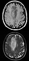 tumor